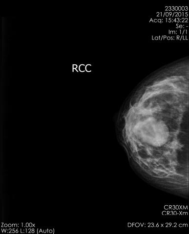 Benign Breast Tumor Dataset | IEEE DataPort